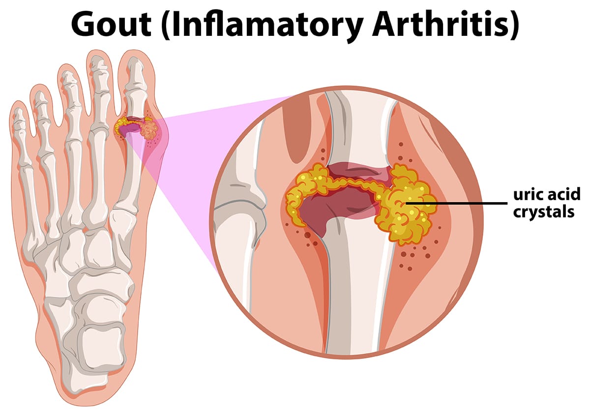 Gout | Spire Orthopaedic