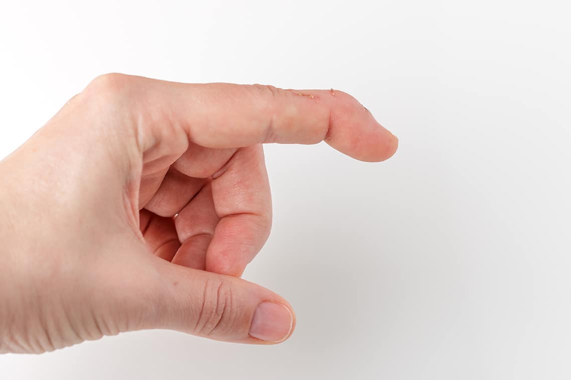 Mallet Finger | Spire Orthopaedic