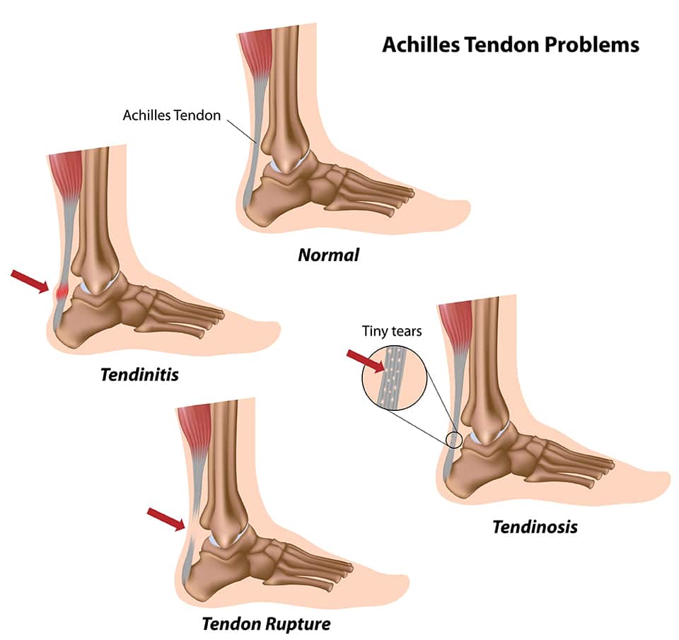 Achilles Tendonitis | Spire Orthopaedic
