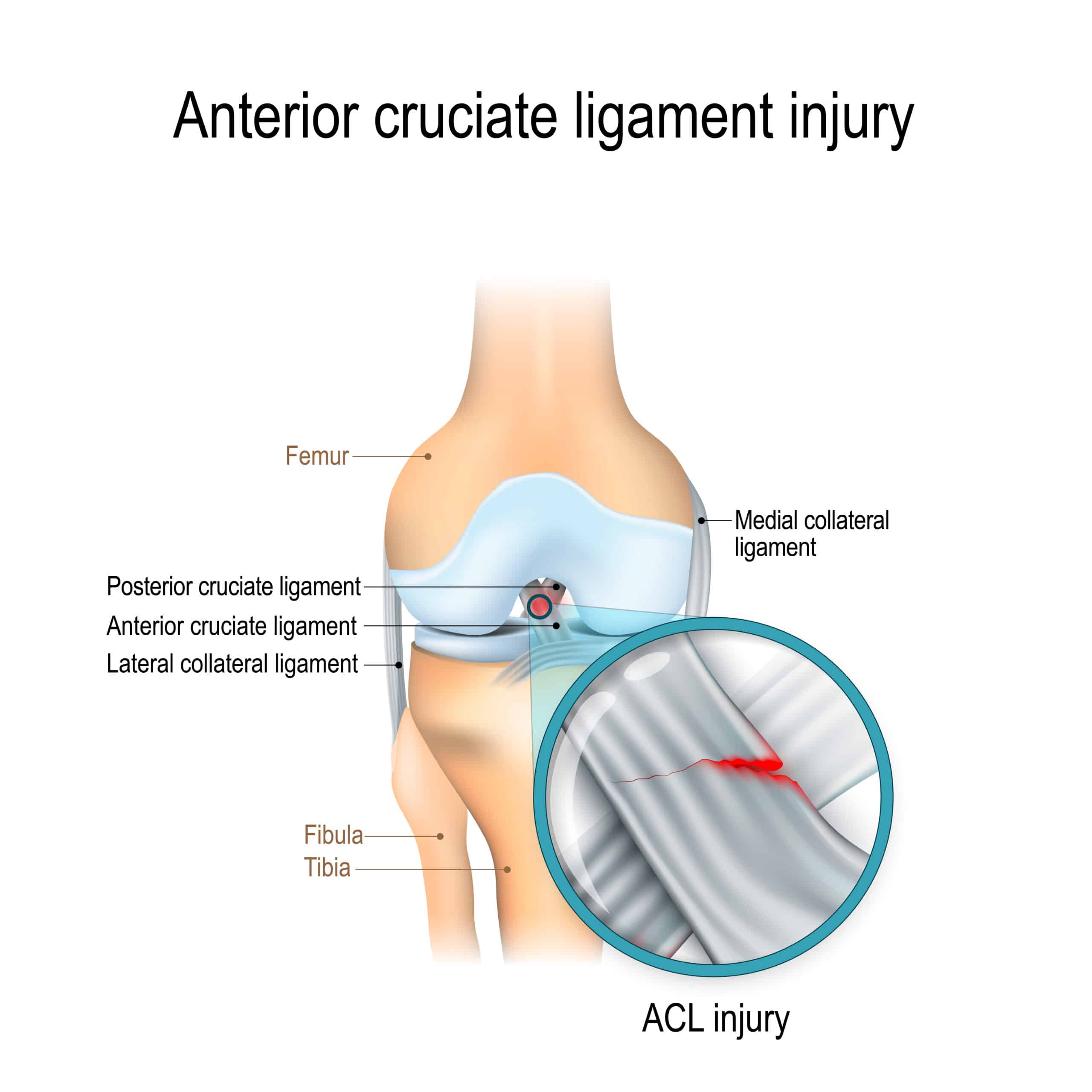 Cruciate Ligament Injury
