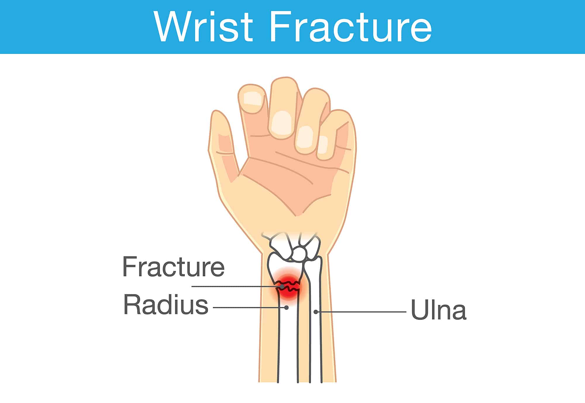Wrist Fracture in Singapore