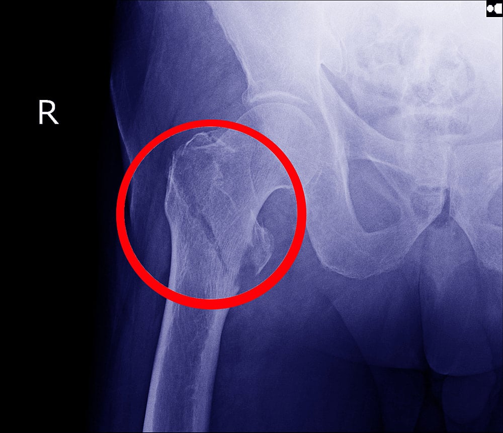 Hip Fracture in Singapore