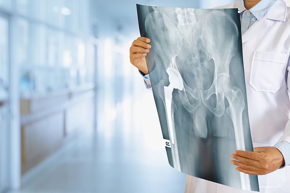 Recommended Treatment for Hip Fracture in Singapore