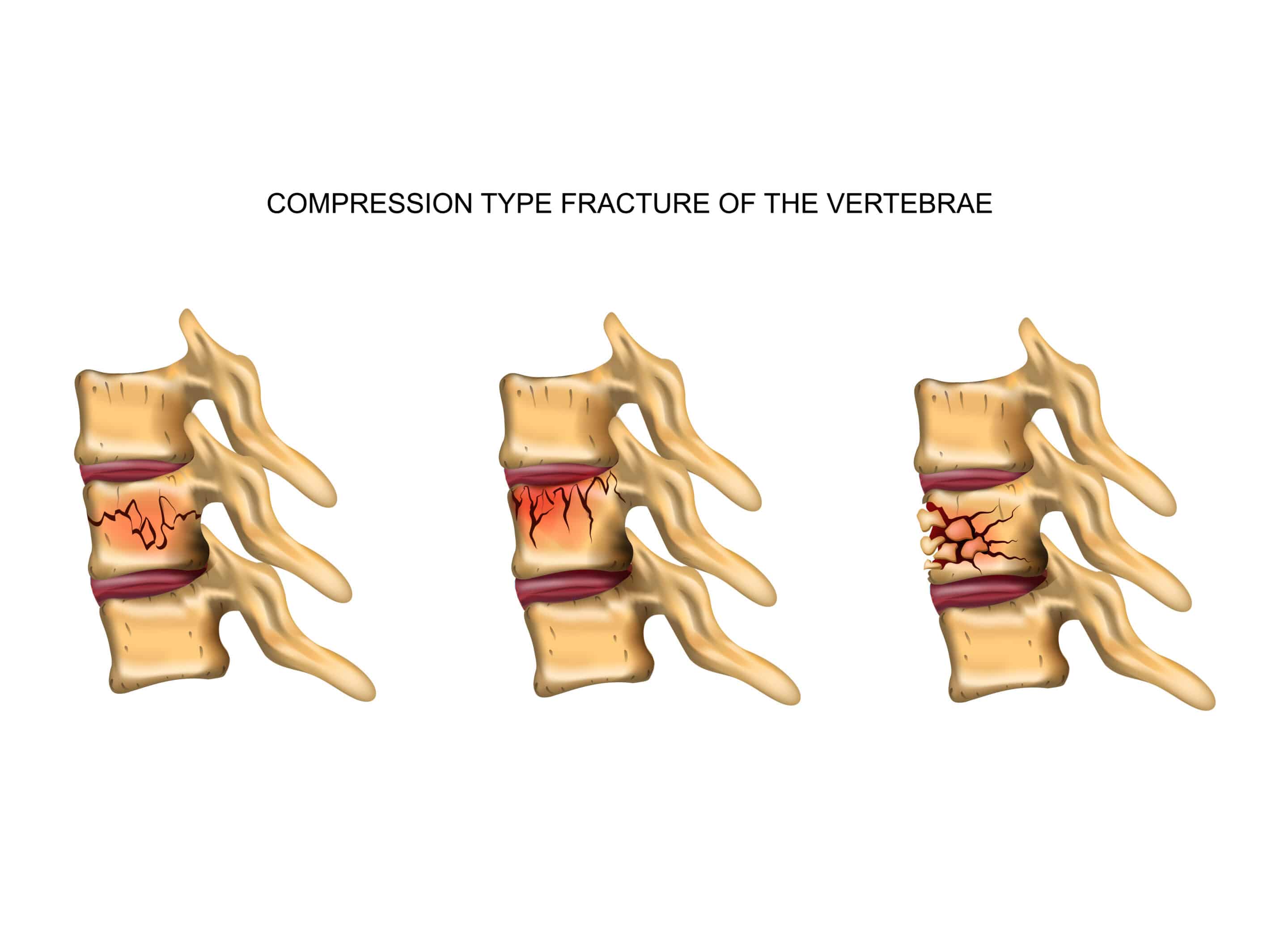 What is a Compression Fracture?