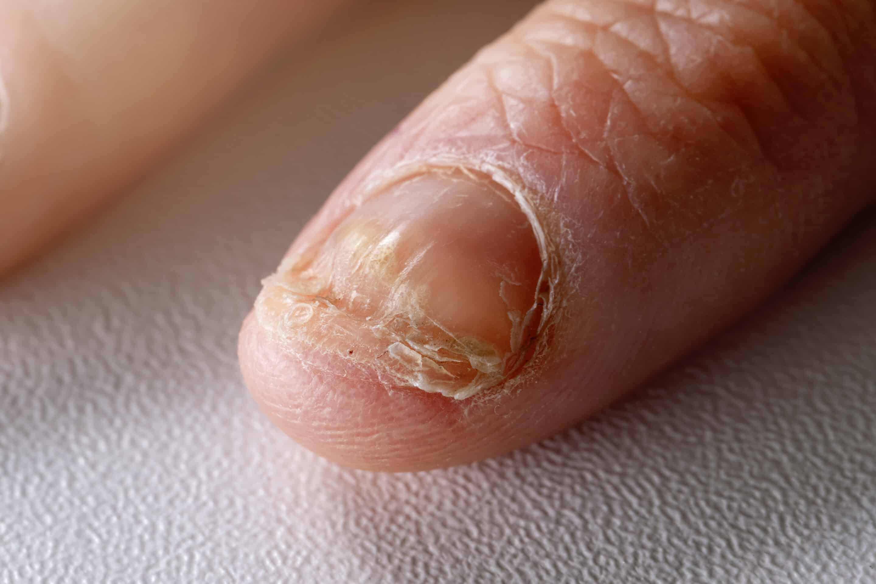 nail bed infection