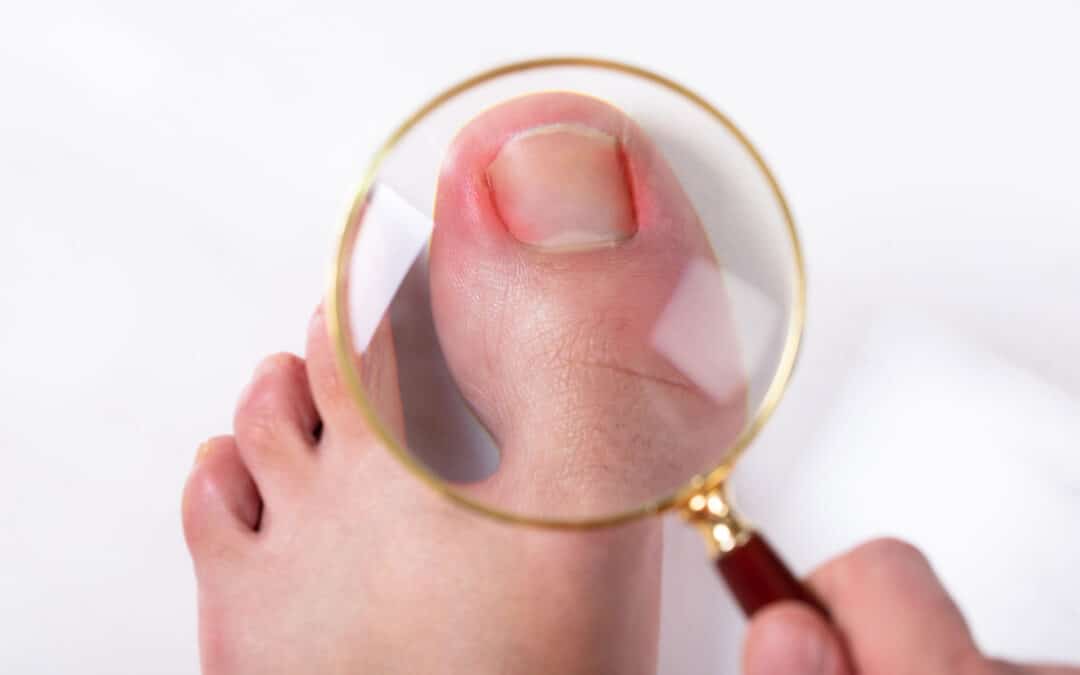 What Happens When You Leave an Ingrown Toenail Untreated?