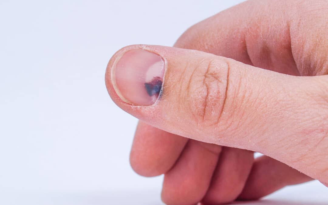 What Happens If a Nail Bed Injury is Left Untreated?