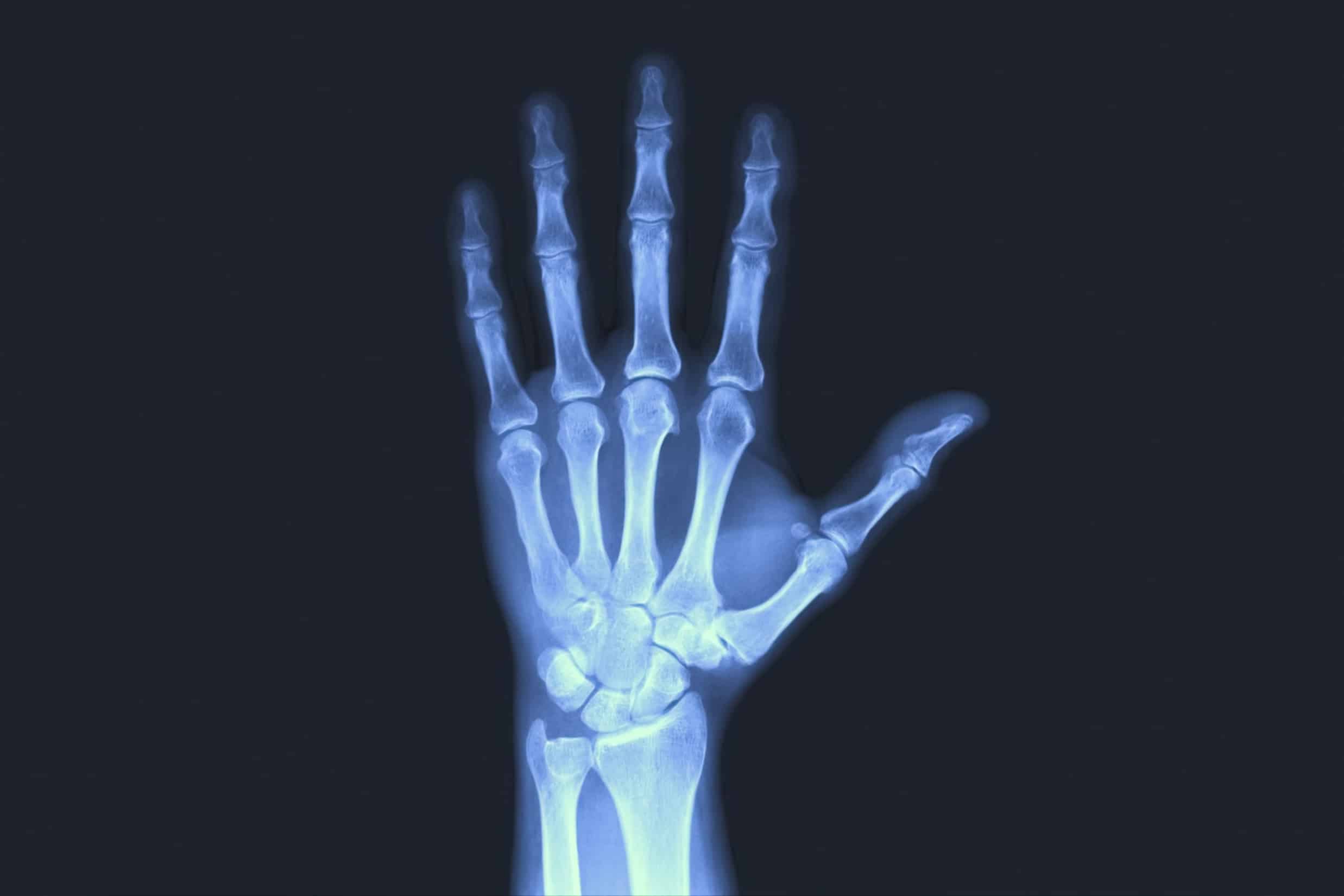 X-rayed human hand. X-ray of hand bones. Hand Fracture - Spire Orthopaedic Centre