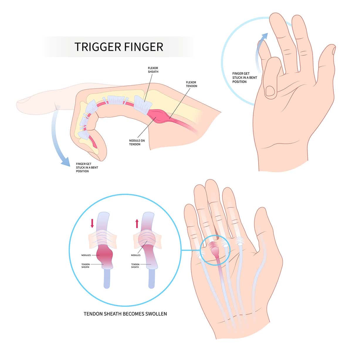Early Signs and Prevention of Trigger Finger - Spire Orthopaedic Centre