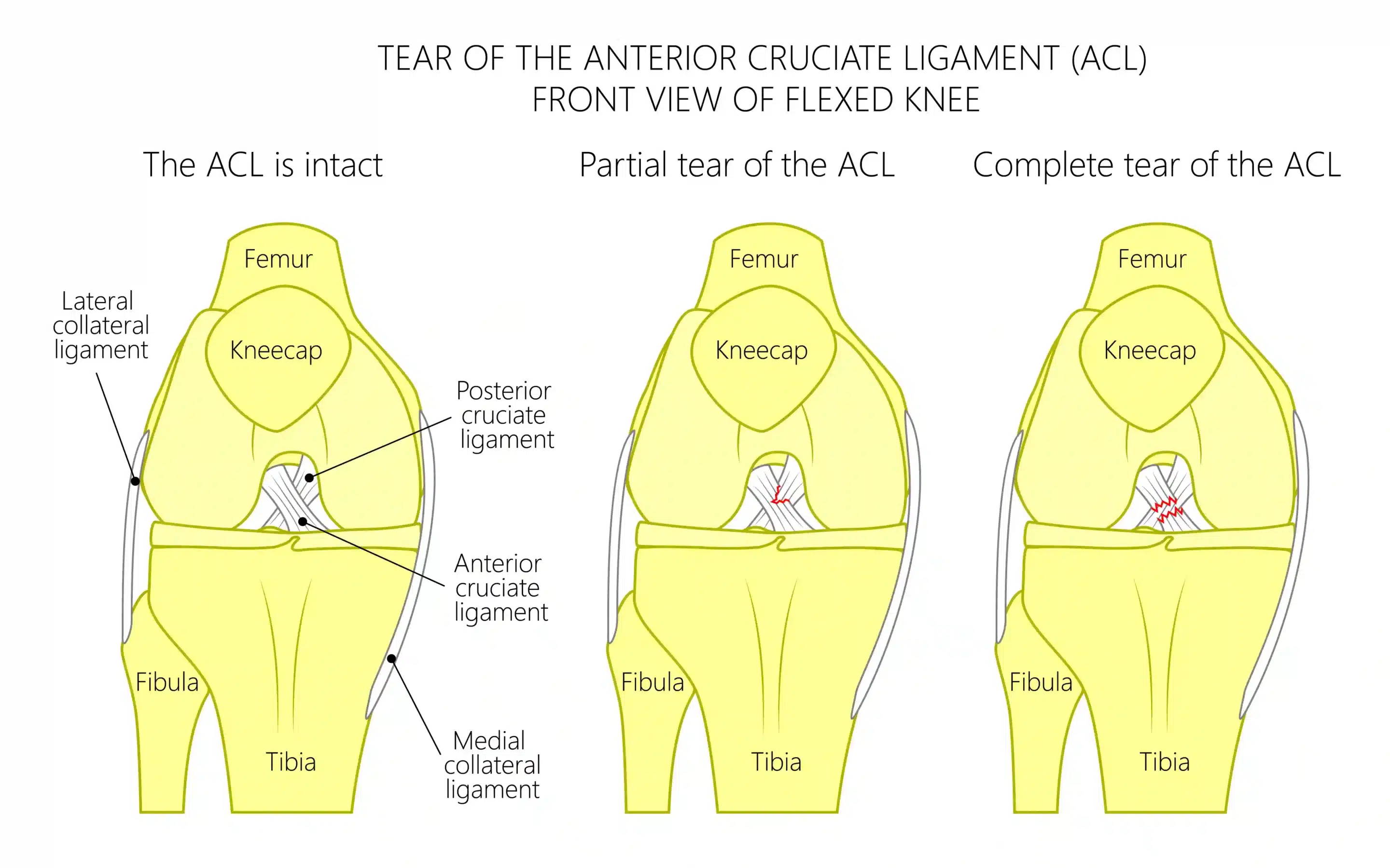 A diagram illustrating the differences between a partial and complete tear of the anterior cruciate ligament (ACL) in a flexed knee, with labels for the knee anatomy including femur, kneecap, tibia, and fibula. Partial ACL Tear vs Complete ACL Tear - Spire Orthopaedic Centre
