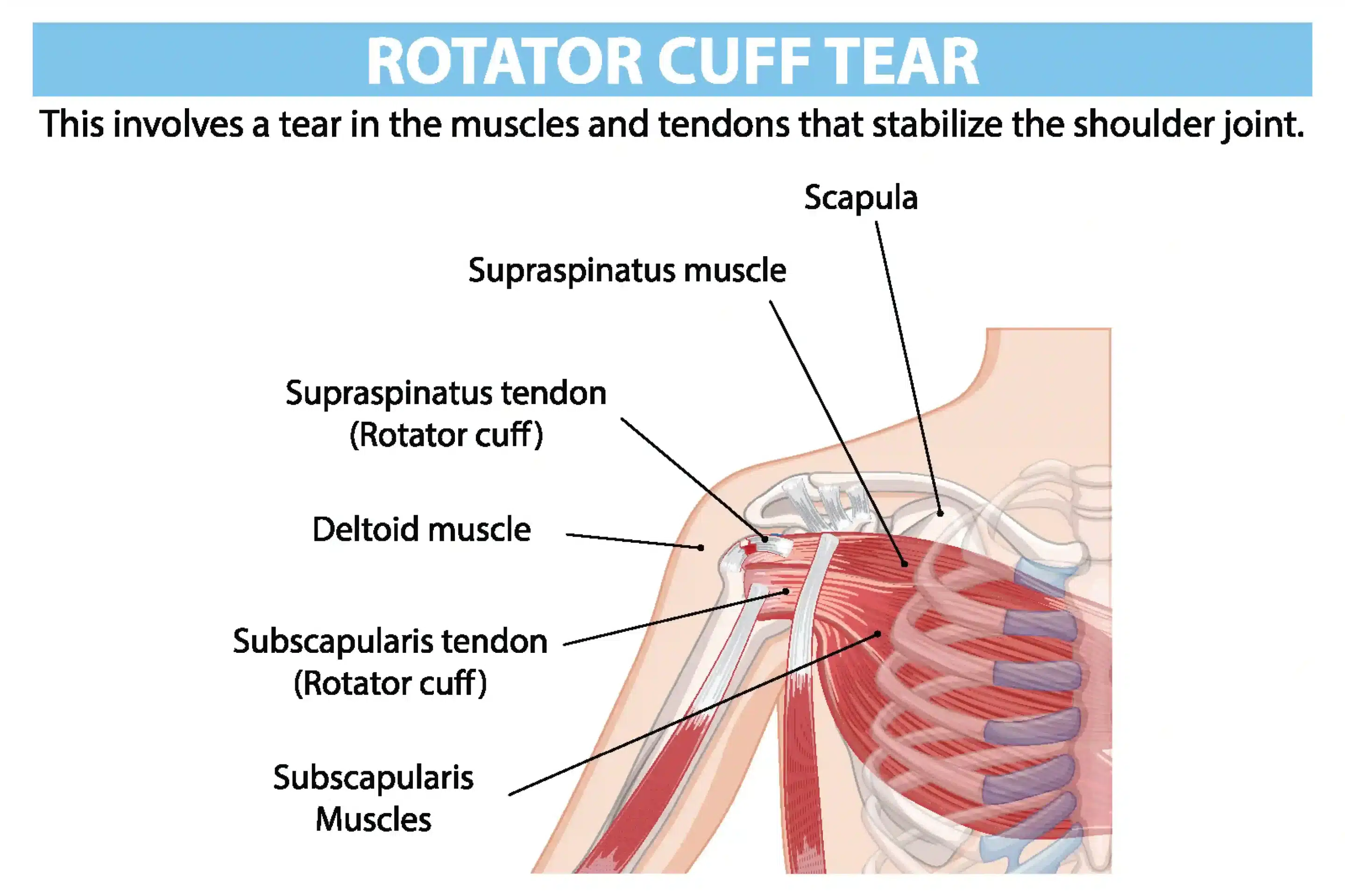 An anatomical illustration showing a rotator cuff tear, including labeled muscles and tendons involved in shoulder stability. Detailed anatomy of shoulder rotator cuff tear - Spire Orthopaedic Centre