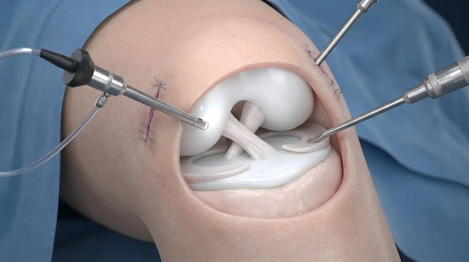 ACL Surgery in Singapore – Spire Orthopaedic Centre ACL Surgery in Singapore - Spire Orthopaedic Centre