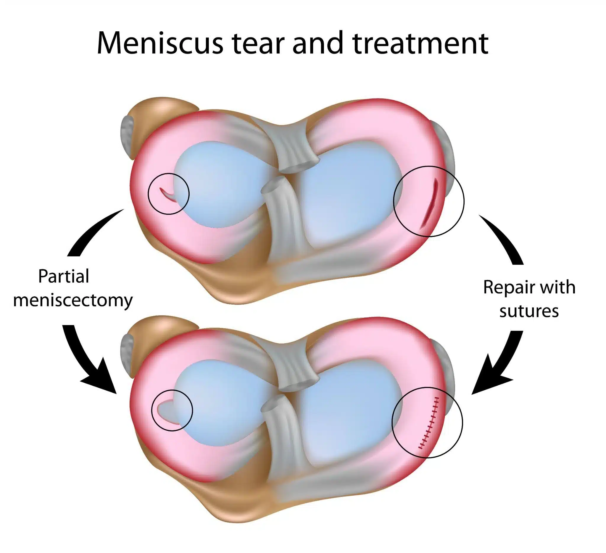 Meniscus tear and surgery treatment – Spire Orthopaedic Centre Meniscus tear and surgery treatment - Spire Orthopaedic Centre